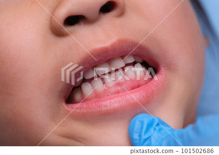 Close-up inside the oral cavity of a healthy child with beautiful rows of baby teeth. Young girl opens mouth revealing upper and lower teeth, hard palate, soft palate, dental and oral health checkup. Close-up inside the oral cavity of a healthy child with beautiful rows of baby teeth. Young girl opens mouth revealing upper and lower teeth, hard palate, soft palate, dental and oral health checkup. 101502686