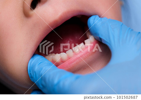 Close-up inside the oral cavity of a healthy child with beautiful rows of baby teeth. Young girl opens mouth revealing upper and lower teeth, hard palate, soft palate, dental and oral health checkup. 101502687