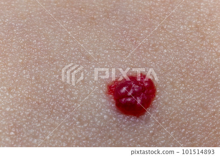 Red mole on skin extreme close-up view 101514893