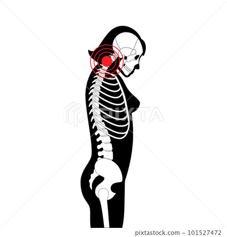 Neck vertebrae deformity 101527472