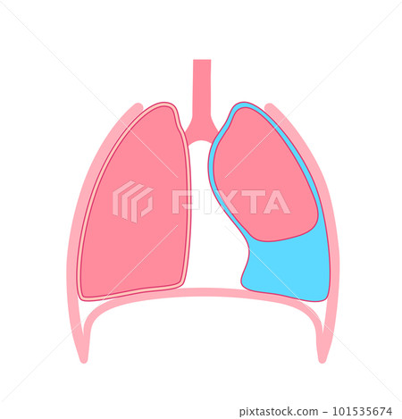 Pleural effusion poster 101535674