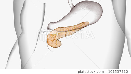 Cystic fibrosis (CF) is a genetic disorder characterized by thick mucus production. Cystic fibrosis (CF) is a genetic disorder characterized by thick mucus production. 101537310
