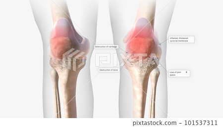 Rheumatoid arthritis (RA) is a chronic, autoimmune, inflammatory condition. 101537311