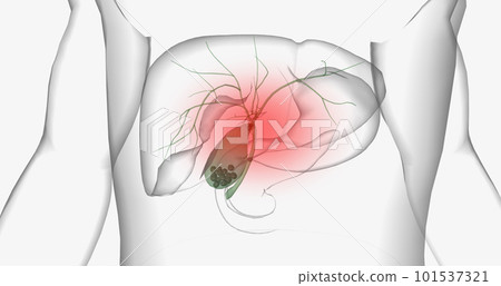 Gallstones are pieces of solid material that form in the gallbladder, a small hollow organ located beneath the liver. Gallstones are pieces of solid material that form in the gallbladder, a small hollow organ located beneath the liver. 101537321