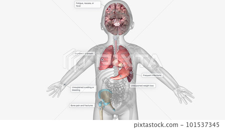 The ALL, Signs and Symptoms The ALL, Signs and Symptoms 101537345