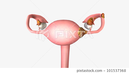 Stage II ovarian tumor has spread to nearby organs, such as the uterus and the body of the fallopian tubes. 101537368