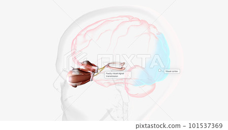 Strabismic Amblyopia, Visual Pathway with Eye Movement Strabismic Amblyopia, Visual Pathway with Eye Movement 101537369