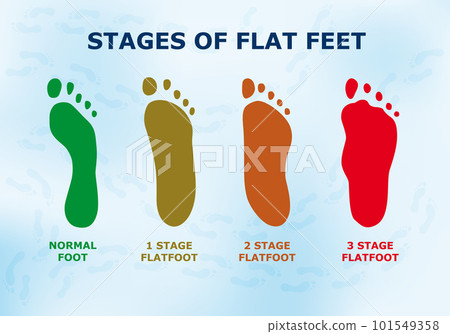 Educational poster about flat feet, different stages of the disease. 101549358