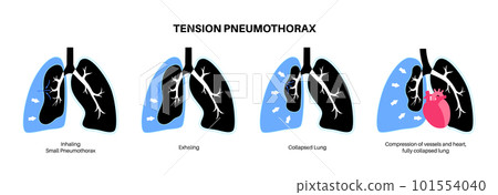 Tension pneumothorax poster 101554040