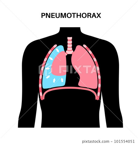 Pneumothorax anatomical poster 101554051