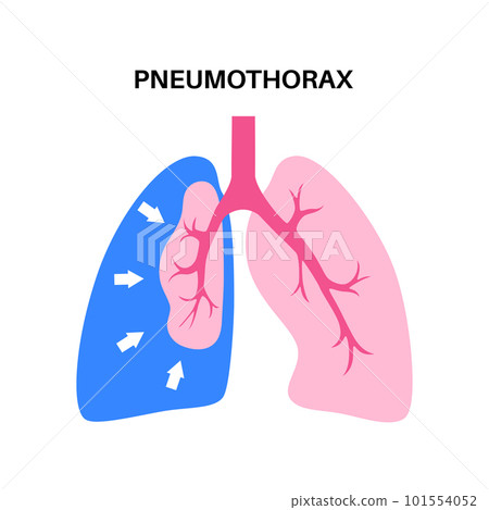 Pneumothorax anatomical poster Pneumothorax anatomical poster 101554052