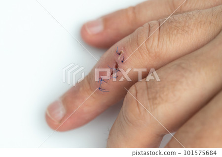 Stitched wound on a finger. Hand with stitched cut wound 101575684
