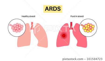 ARDS anatomical poster 101584723