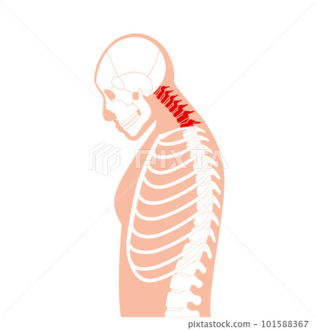 Neck vertebrae deformity 101588367