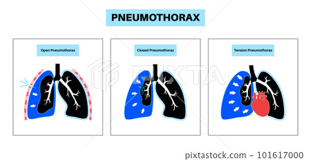 Pneumothorax anatomical poster Pneumothorax anatomical poster 101617000