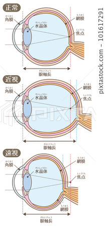 眼睛的結構_視力（近視/遠視） 101617291