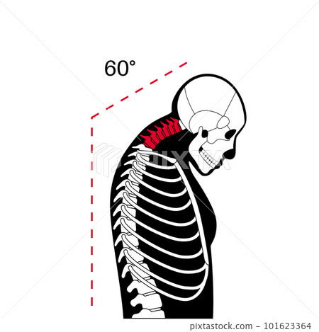Neck vertebrae deformity 101623364