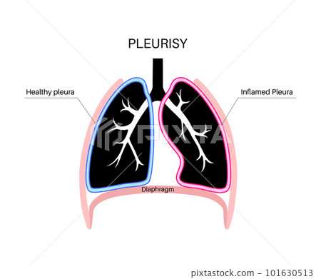 Pleurisy inflammation diseases 101630513