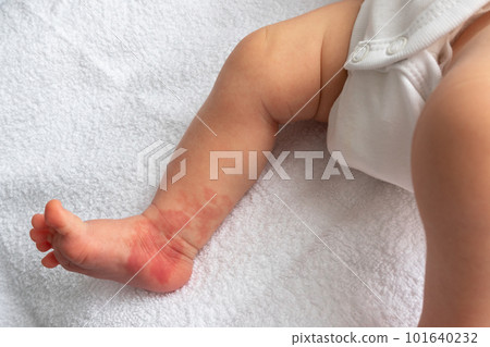 Hemangioma red birthmark on the leg of newborn baby 101640232