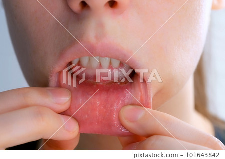 Stomatitis in woman's mouth after dental treatment, disease in the mouth. Stomatitis in woman's mouth after dental treatment, disease in the mouth. 101643842