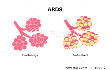 ARDS anatomical poster 101653178