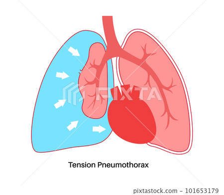 Tension pneumothorax poster 101653179