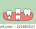 teeth are growing up from the gum by permanent tooth located below primary tooth, first tooth - dental cartoon vector flat style 101660521