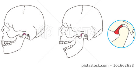 Illustration of temporomandibular disorder Illustration of temporomandibular disorder 101662658