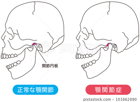 正常顳下頜關節與顳下頜關節紊亂的比較 101662890