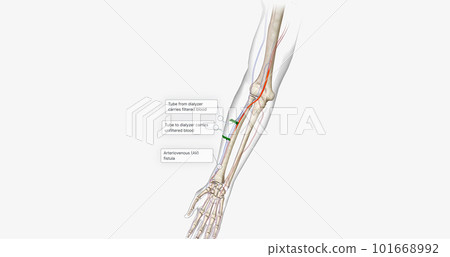 Dialysis is a procedure that filters blood outside the body and returns the filtered blood to the bloodstream. Dialysis is a procedure that filters blood outside the body and returns the filtered blood to the bloodstream. 101668992