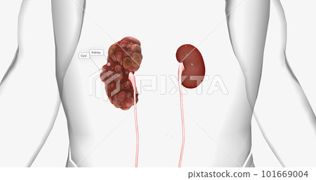 Polycystic kidney disease (PKD) is an inherited disorder of the kidneys. 101669004