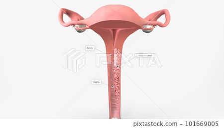 In stage III, the cancer has moved to the lower part of the vagina 101669005
