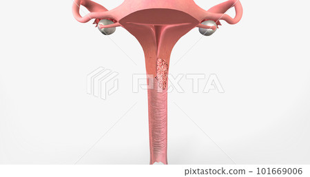 In stage II, the cancer has invaded the upper part of the vagina and tissue near the uterus called the parametrium. In stage II, the cancer has invaded the upper part of the vagina and tissue near the uterus called the parametrium. 101669006