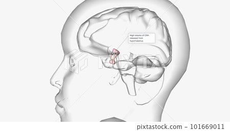 High volume of CRH released from hypothalamus High volume of CRH released from hypothalamus 101669011