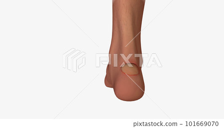 Blisters often form on the heels of the feet and inner gripping surfaces of the hands. Blisters often form on the heels of the feet and inner gripping surfaces of the hands. 101669070