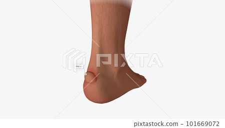 Blisters often form on the heels of the feet and inner gripping surfaces of the hands. Blisters often form on the heels of the feet and inner gripping surfaces of the hands. 101669072