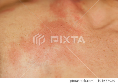 Removal of papillomas on the body Removal of papillomas on the body 101677989