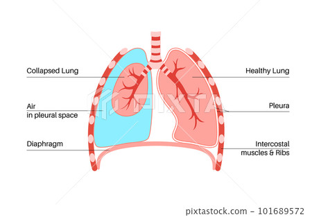 Pneumothorax anatomical poster 101689572
