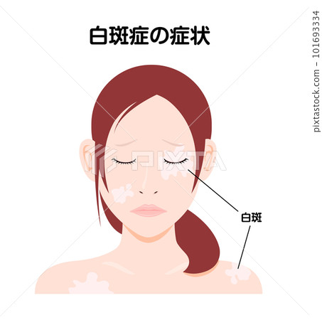 Illustration of a young woman suffering from symptoms of vitiligo Illustration of a young woman suffering from symptoms of vitiligo 101693334