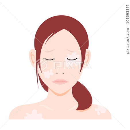 Illustration of a young woman suffering from symptoms of vitiligo / no text Illustration of a young woman suffering from symptoms of vitiligo / no text 101693335