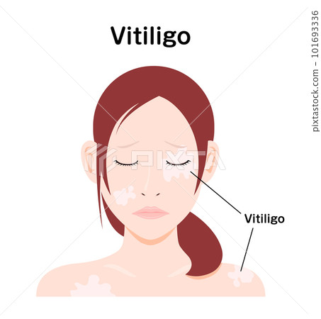 Illustration of a young woman suffering from vitiligo symptoms / English Illustration of a young woman suffering from vitiligo symptoms / English 101693336