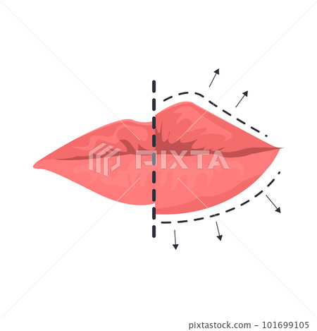 Lip augmentation illustration in color cartoon style. Editable vector graphic design. Lip augmentation illustration in color cartoon style. Editable vector graphic design. 101699105