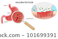 Helicobacter pylori infection in stomach ulcer under magnification. 101699391