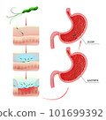Gastritis and ulcer development process in stomach 101699392