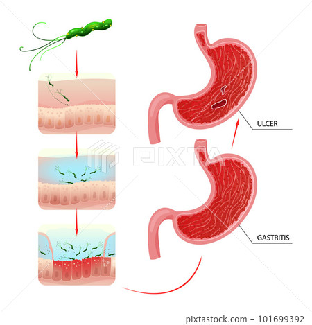 Gastritis and ulcer development process in stomach Gastritis and ulcer development process in stomach 101699392