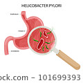 Helicobacter pylori in stomach ulcer 101699393