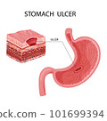 Peptic ulcer in stomach illustration 101699394