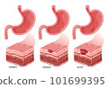 Stomach erosion and ulcer development illustration 101699395