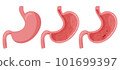 Peptic ulcer in human stomach 101699397