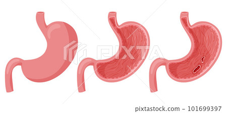 Peptic ulcer in human stomach 101699397